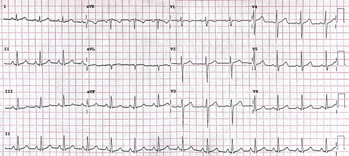 Course - 12-Lead ECG Interpretation