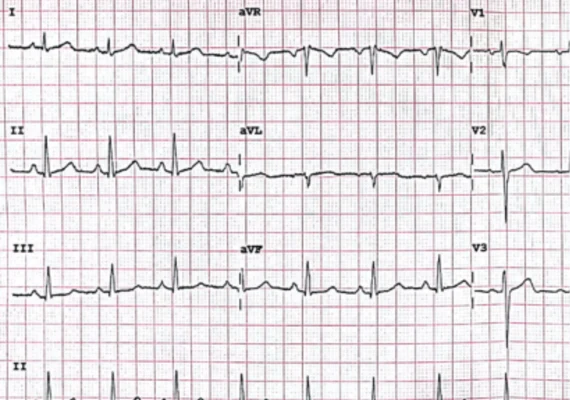 Course - 12-Lead ECG Interpretation